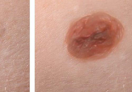 Mole Removal: What You Need to Know
